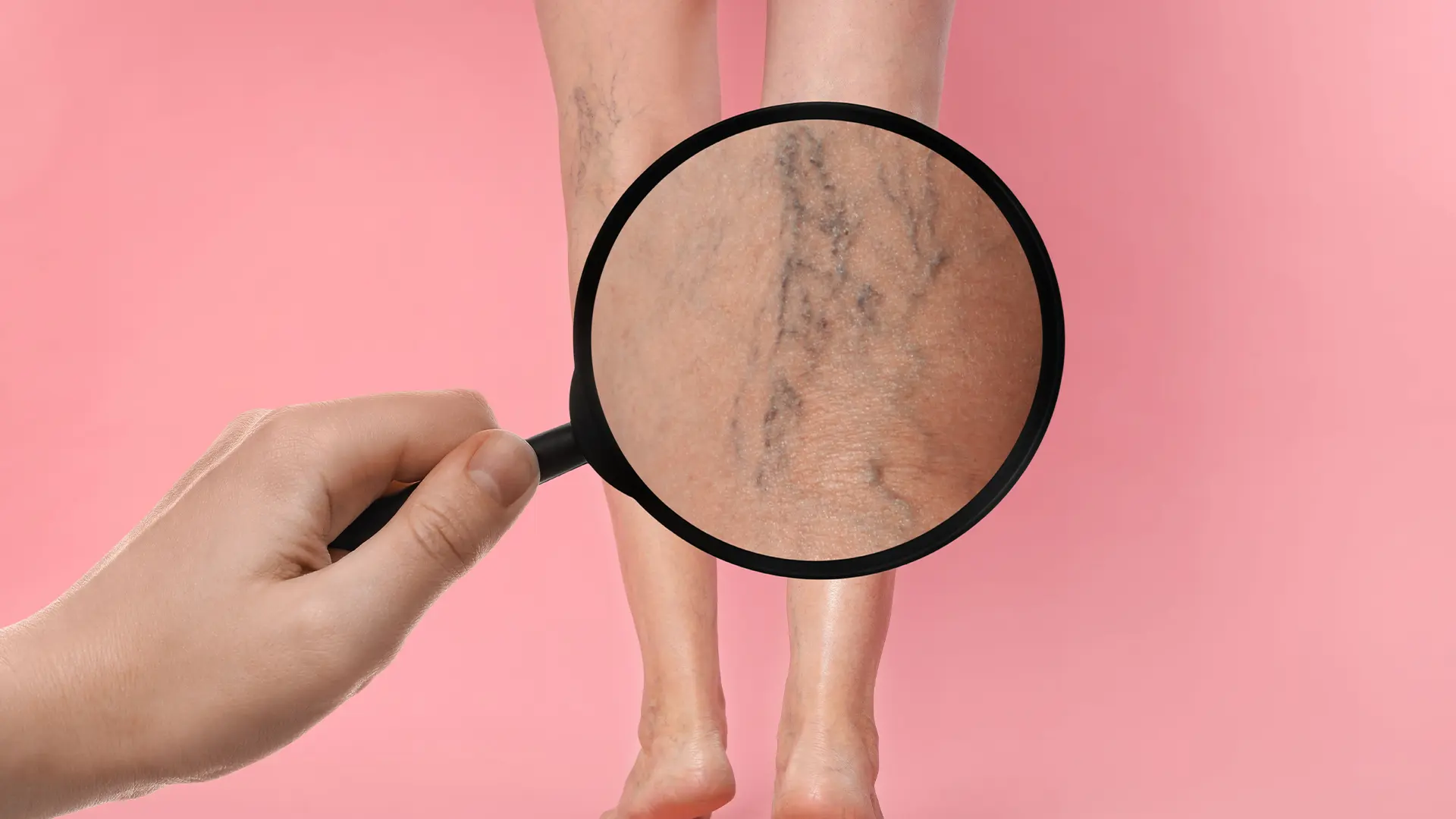 Ce schimbări ar trebui să facem pentru a evita apariția varicelor