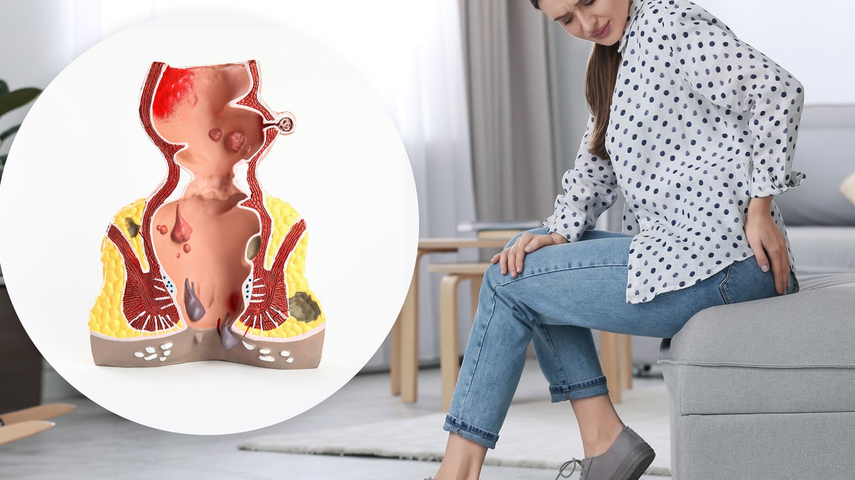 Hemoroizii – O problemă frecventă, dar tratabilă